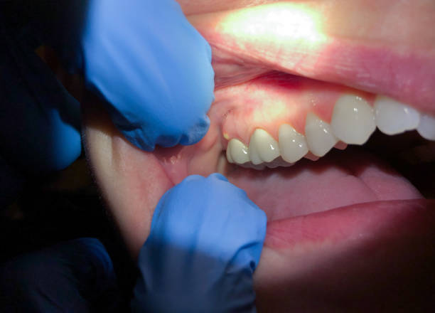 Best Tooth Infection Emergency Dentist  in Peach Lake, NY